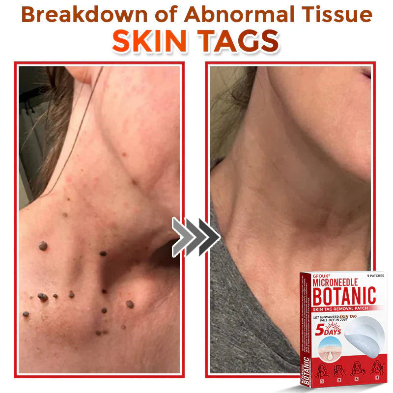 MicroNeedle Botanic Skin Tag Removal Patch