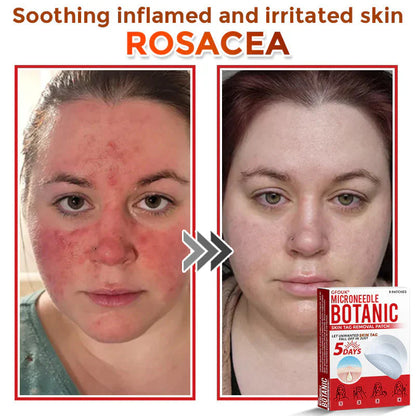 MicroNeedle Botanic Skin Tag Removal Patch